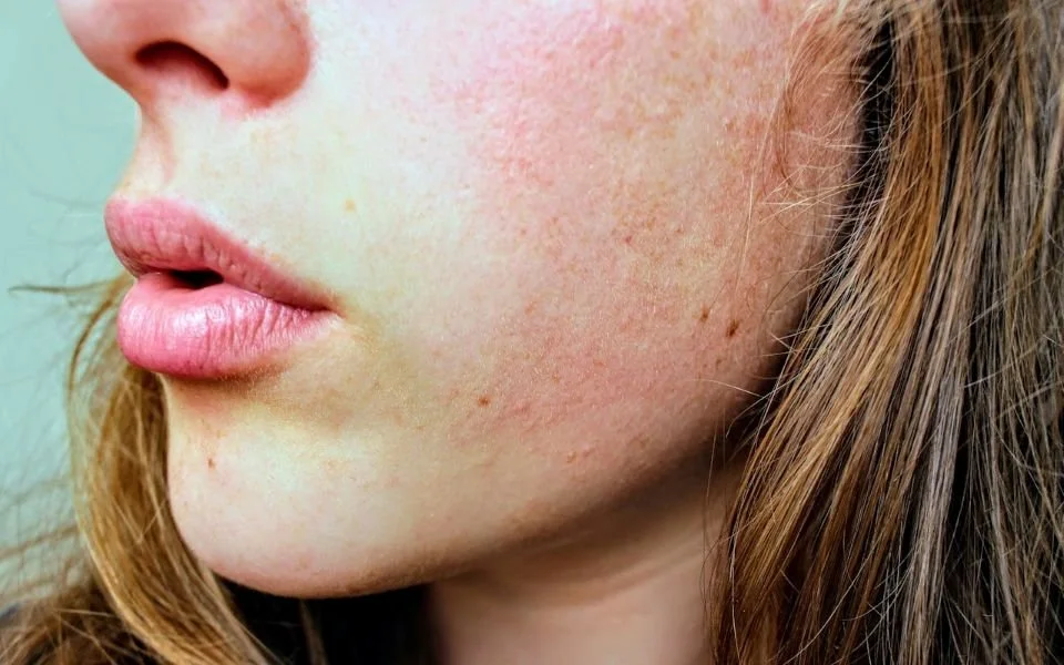 Rosacea Face: How to Identify Your Subtype and Find the Right Treatment