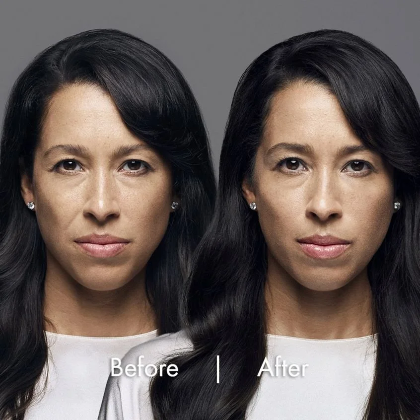 Teoxane before and after calgary.jpg