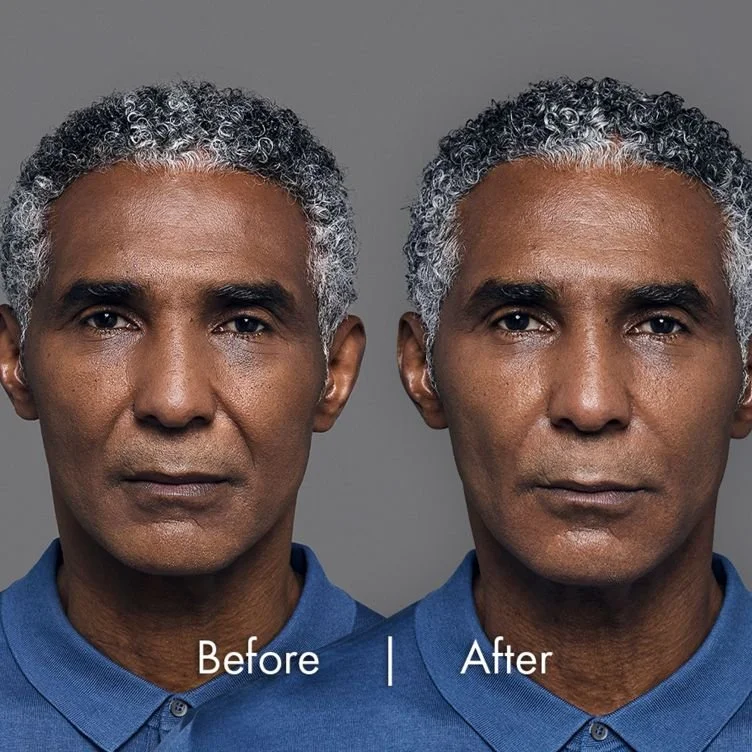 teoxane before after calgary.jpg