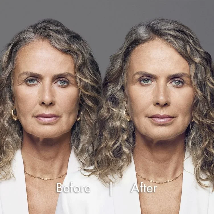 Calgary Guide to Teoxane Lip Fillers