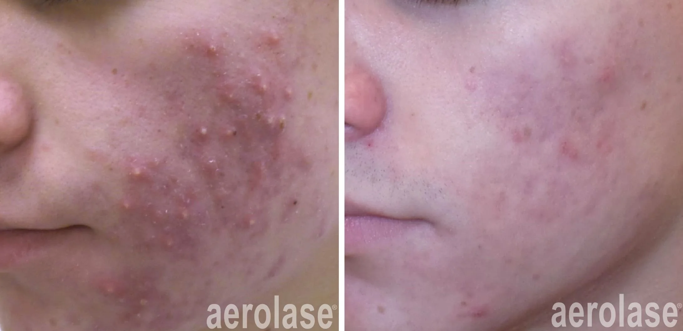 before and after of aerolase acne treatment
