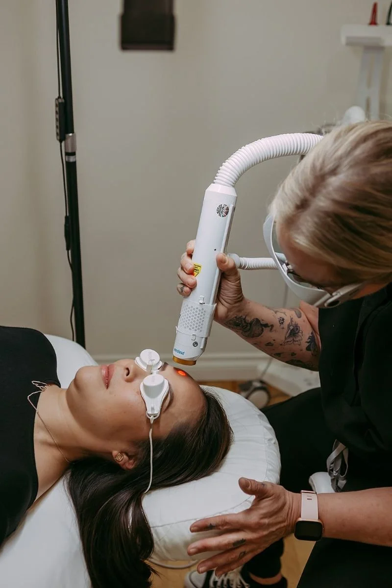 aerolase neo elite top rated laser treatment calgary for skin toning, acne, skin rejuvenation