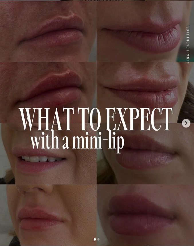 mini lip filler before and after in calgary, ab