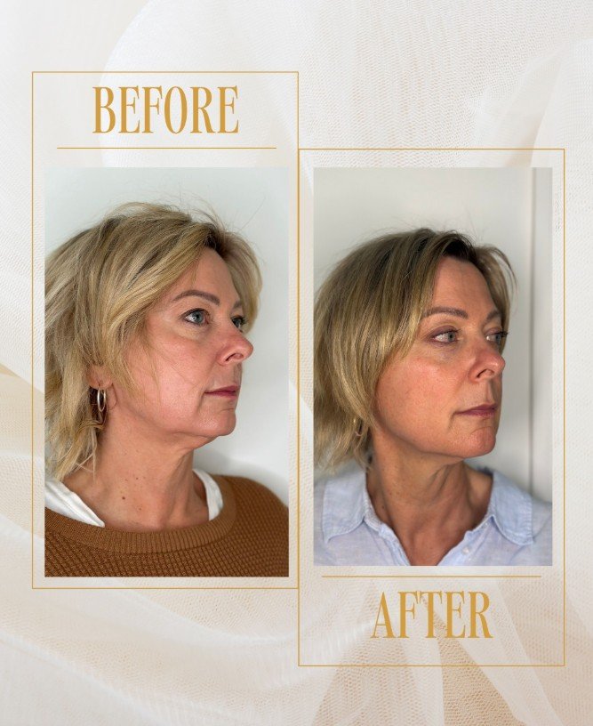 HIFU before and after treatment in Calgary