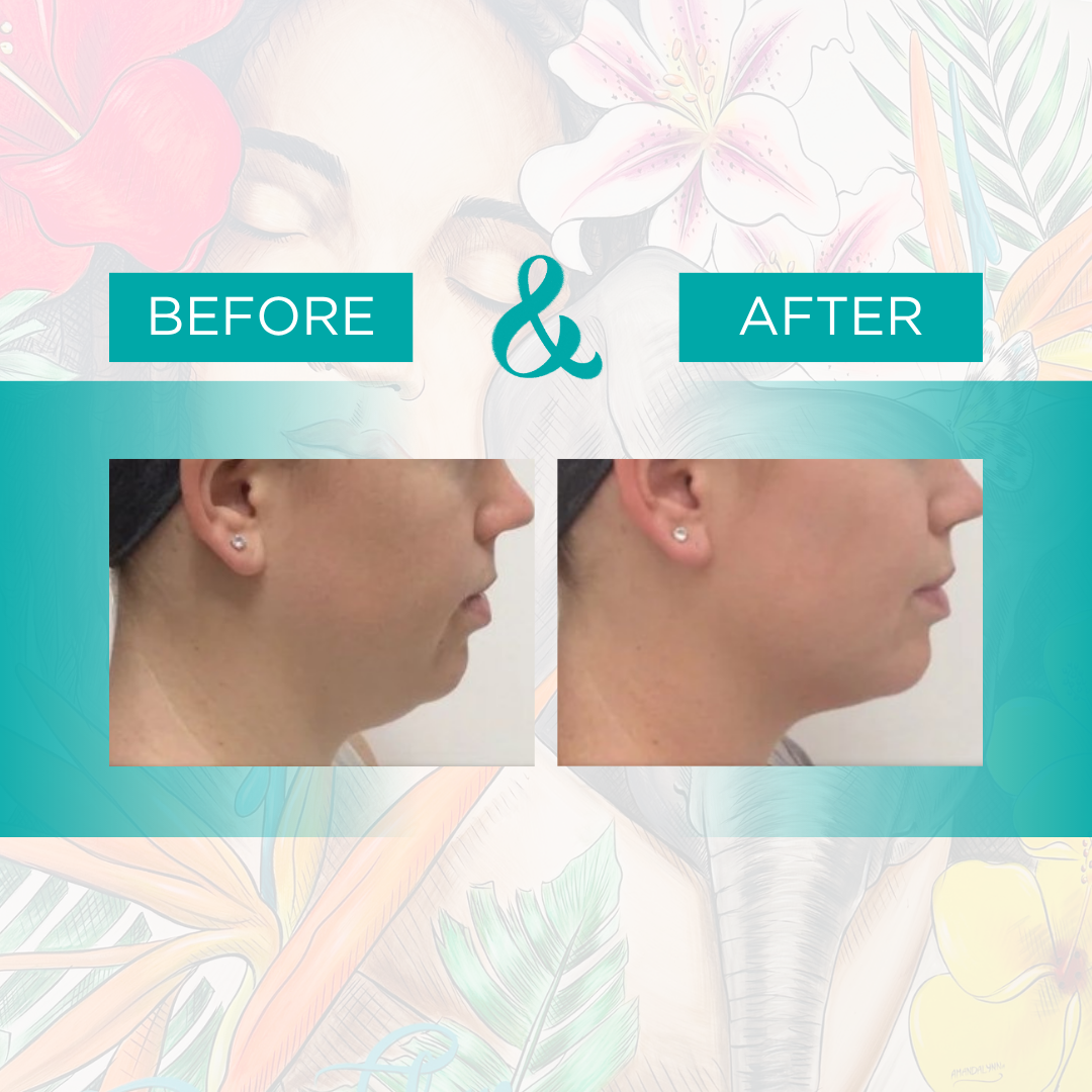 kybella 2.png