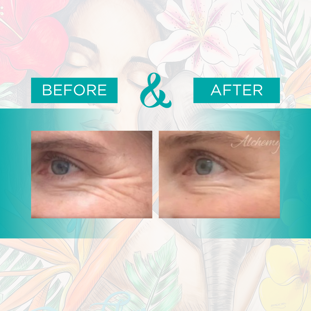 botox 2.png