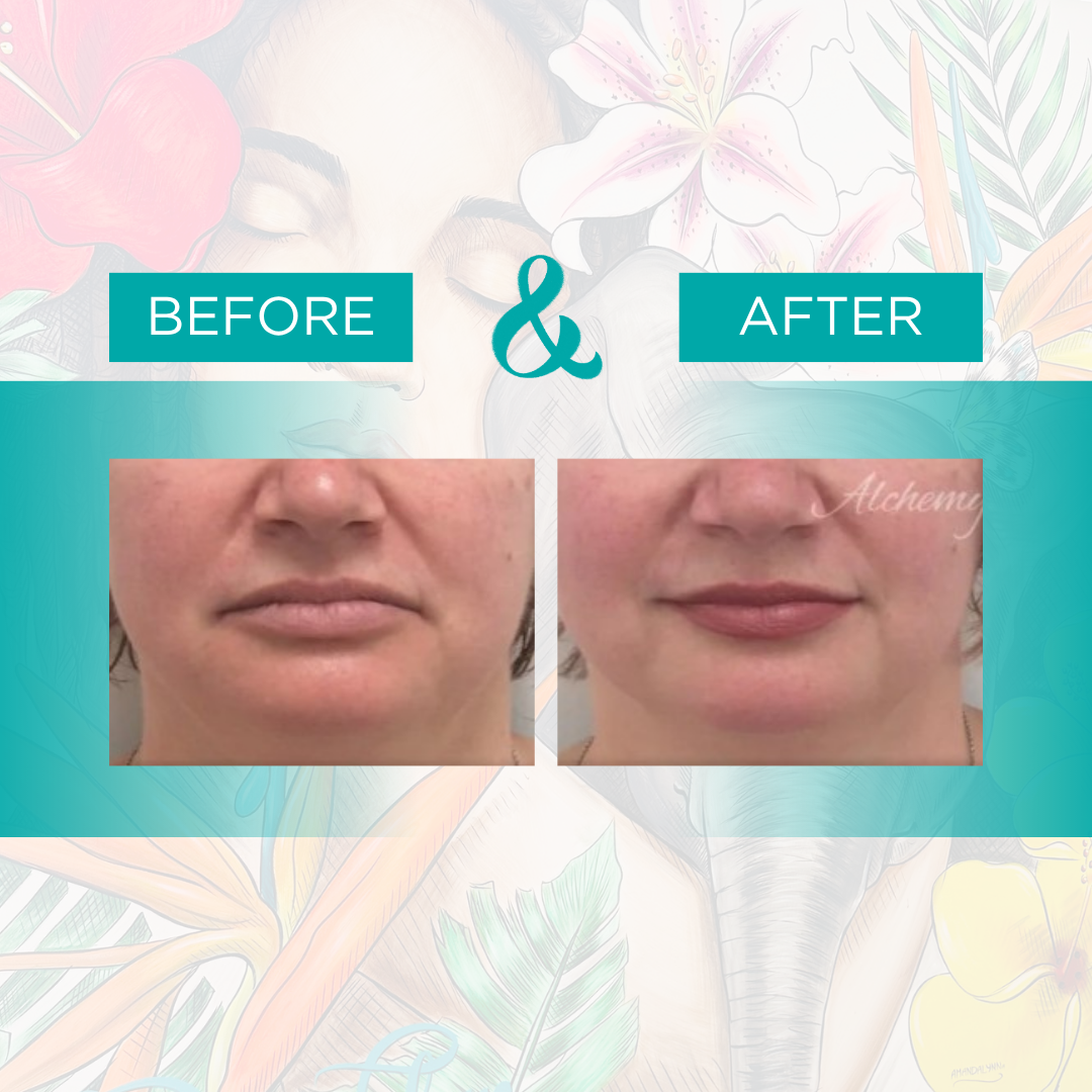 botox 5.png