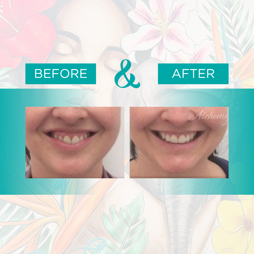 botox 6.png