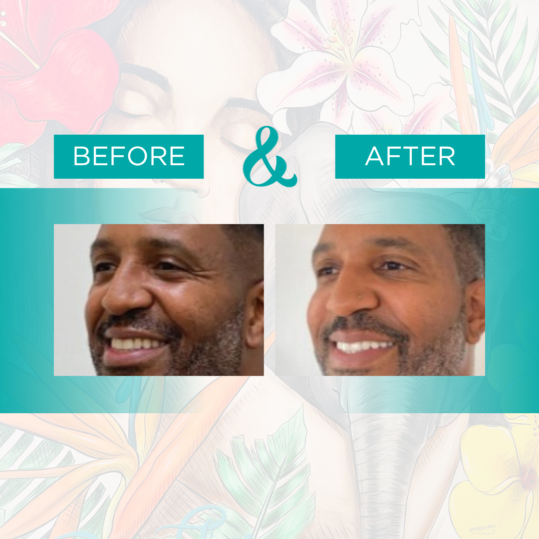 botox 8.png