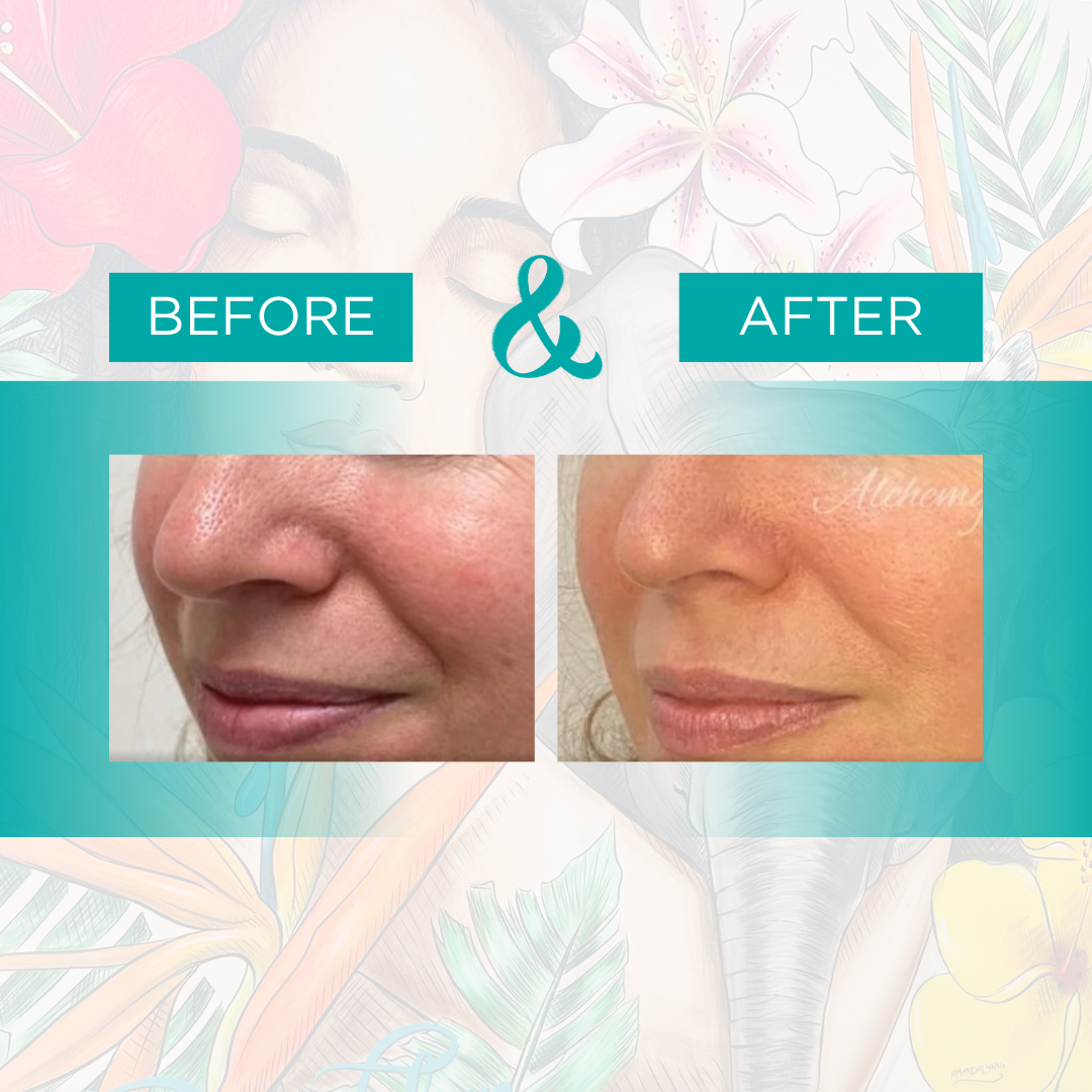 microneedling.png