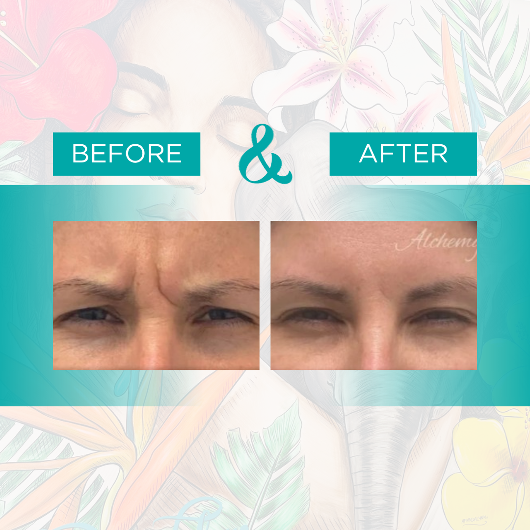 botox 1.png