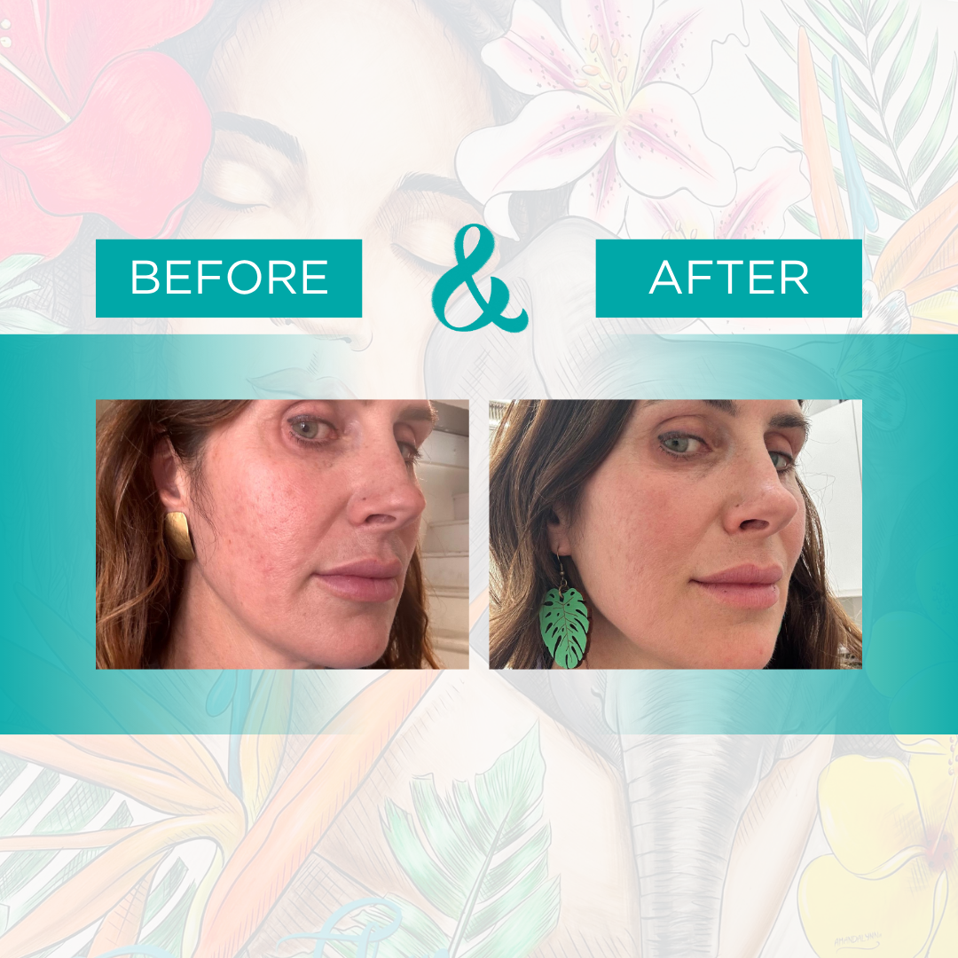 rf microneedling.png