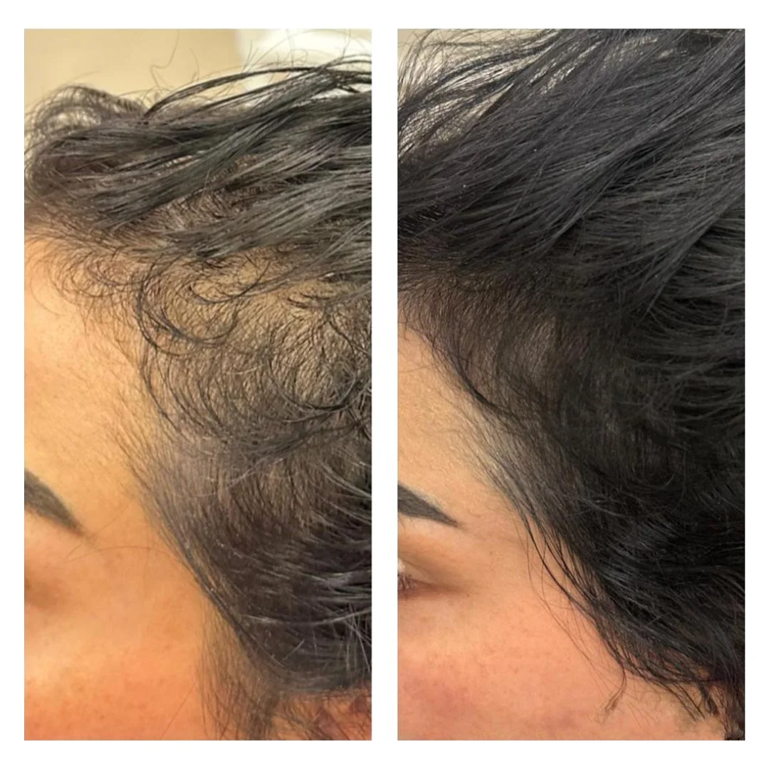Exosome Microneedling in Brampton: Why Purasomes Is Stealing PRP's Spotlight