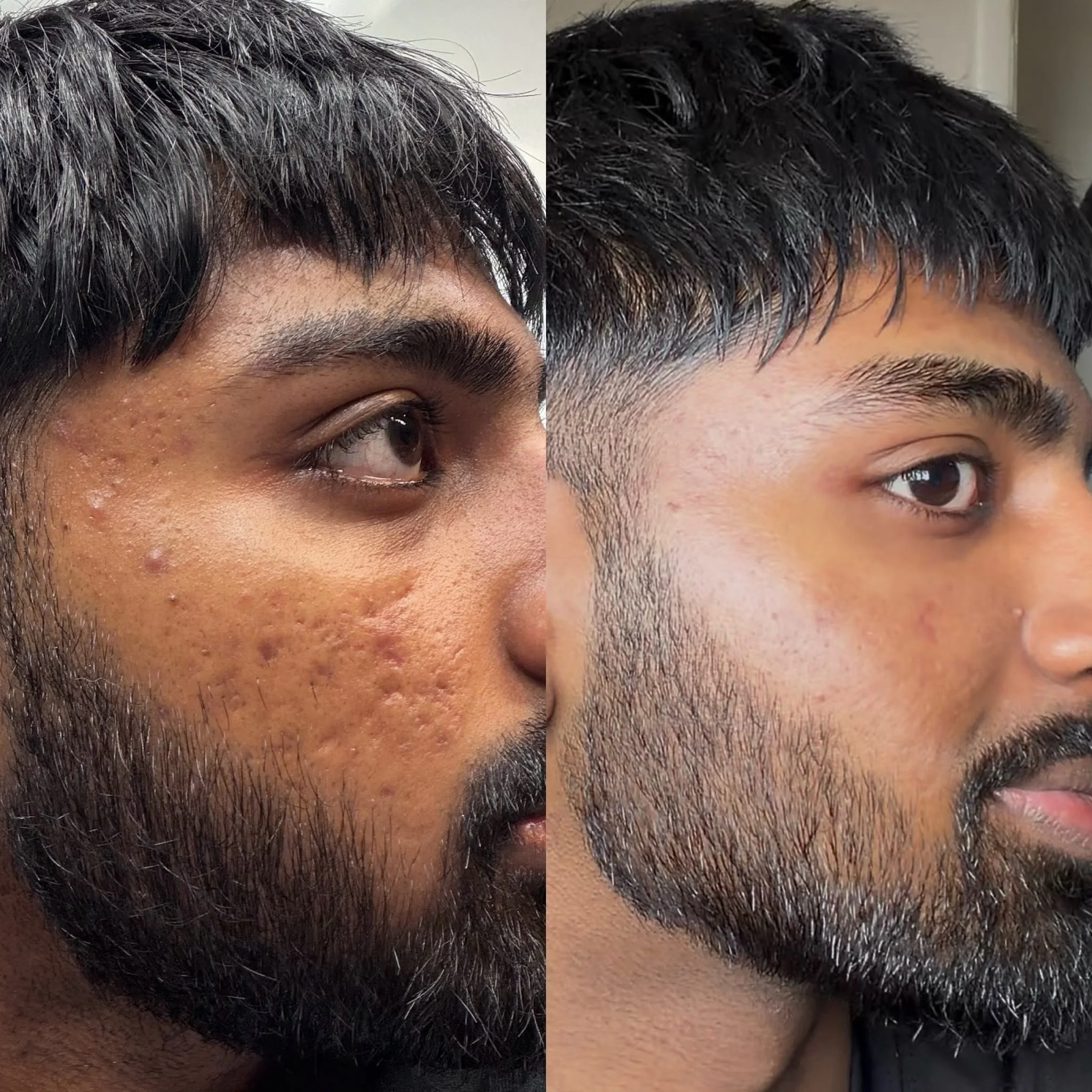 acne scarring and texture.jpeg
