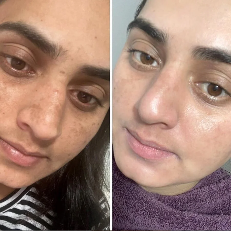 melasma peel before after.jpeg
