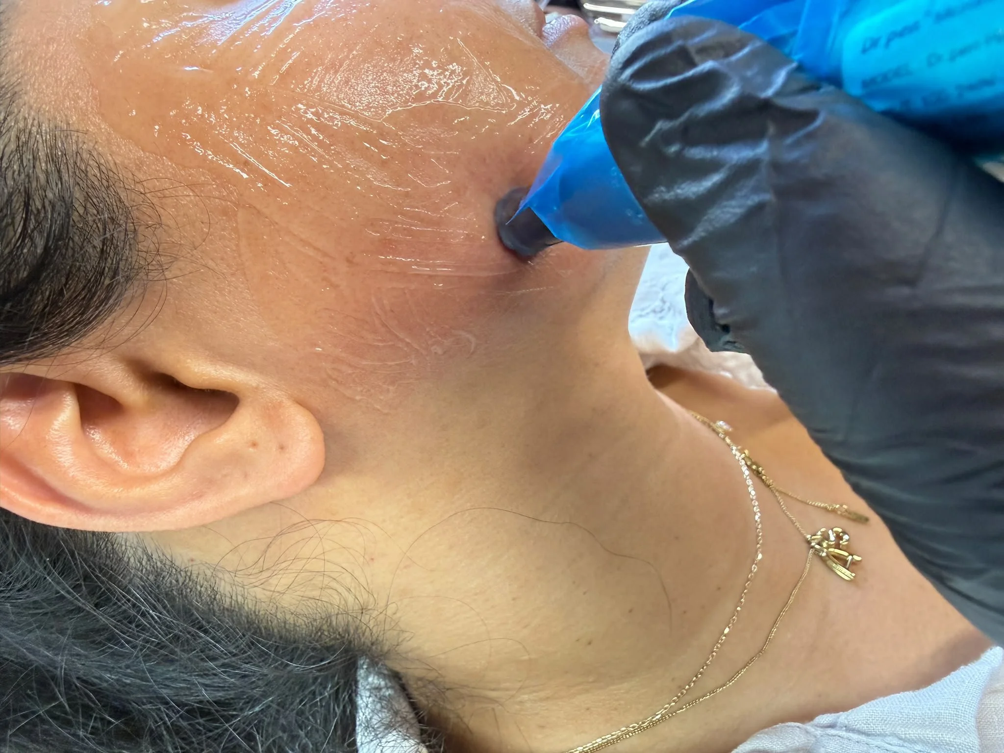 MICRONEEDLNG.jpeg