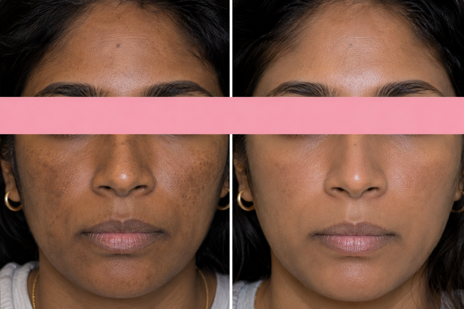 Melasma vs. Hyperpigmentation: What’s Actually Causing Those Dark Patches?