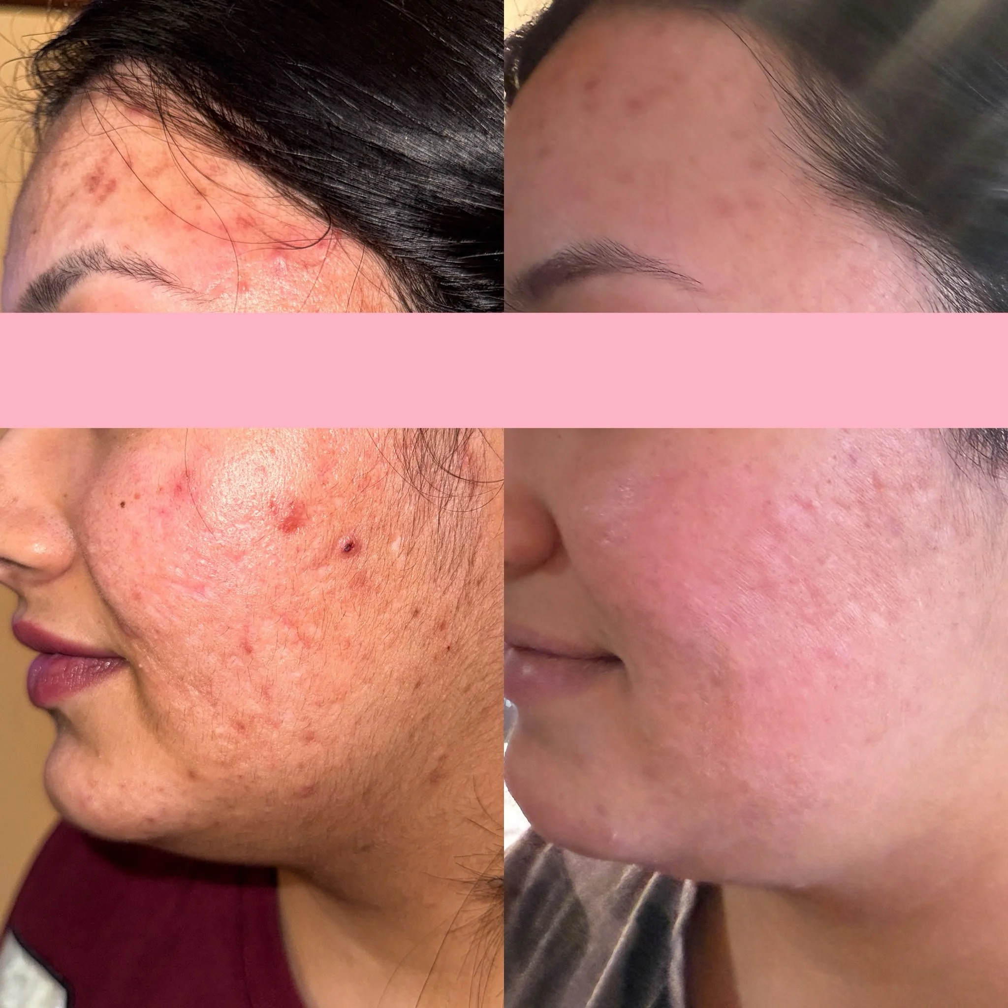 Acne and Internal Health: How Hormones, Diet, Stress and Sleep Can Influence Breakouts
