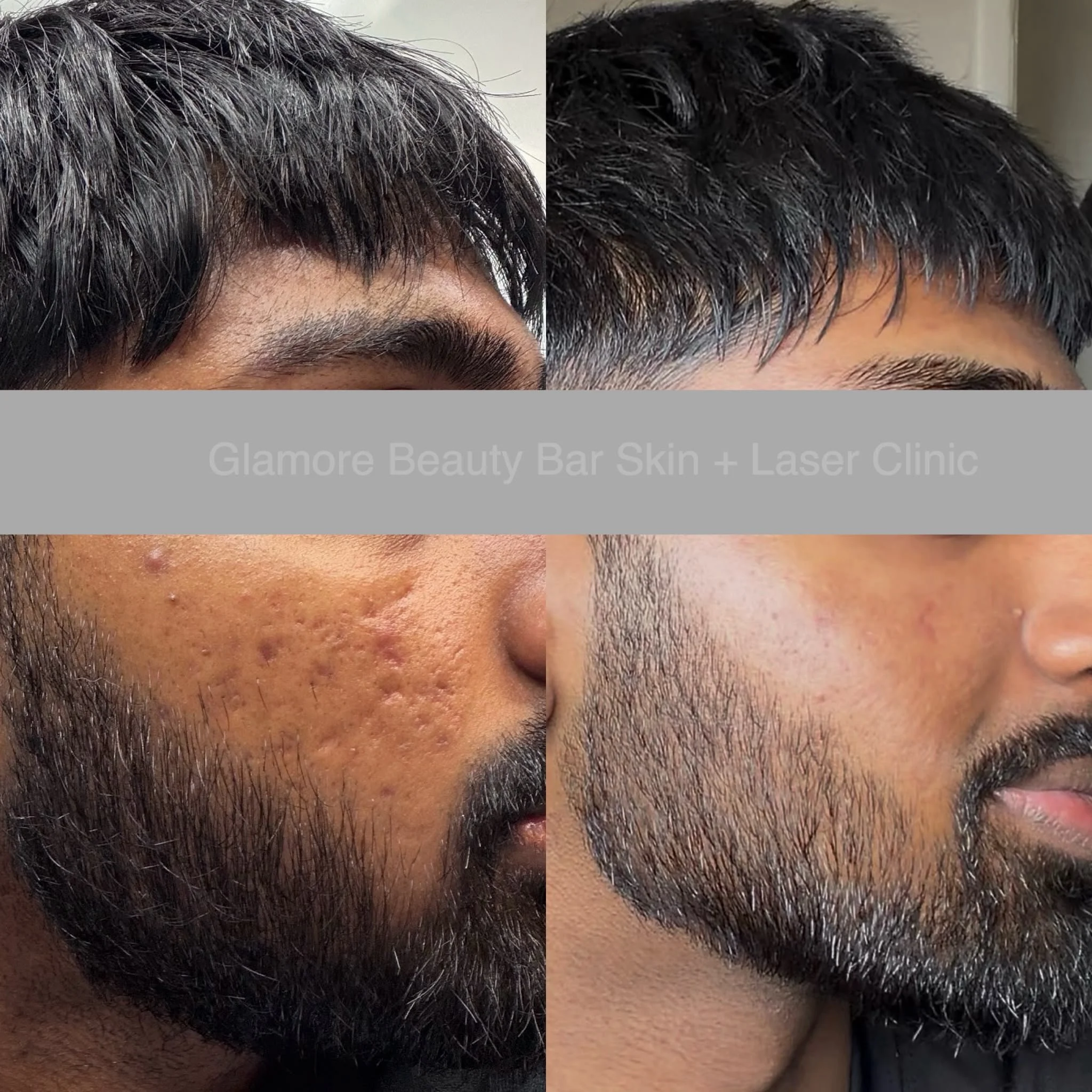Purasomes Exosomes Microneedling Acne scar treatment In Brampton