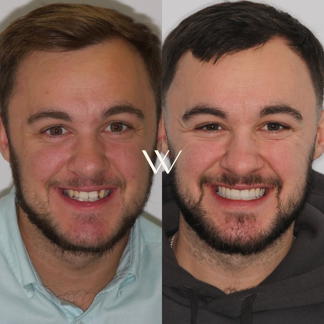 ✨ Another amazing smile makeover by @omer_ortho ✨ This transformation has been achieved through Invisalign, whitening, and composite bonding! 🦷 Ready to transform your smile? Don&rsquo;t miss out on our Invisalign promotion day! Book now and enjoy &