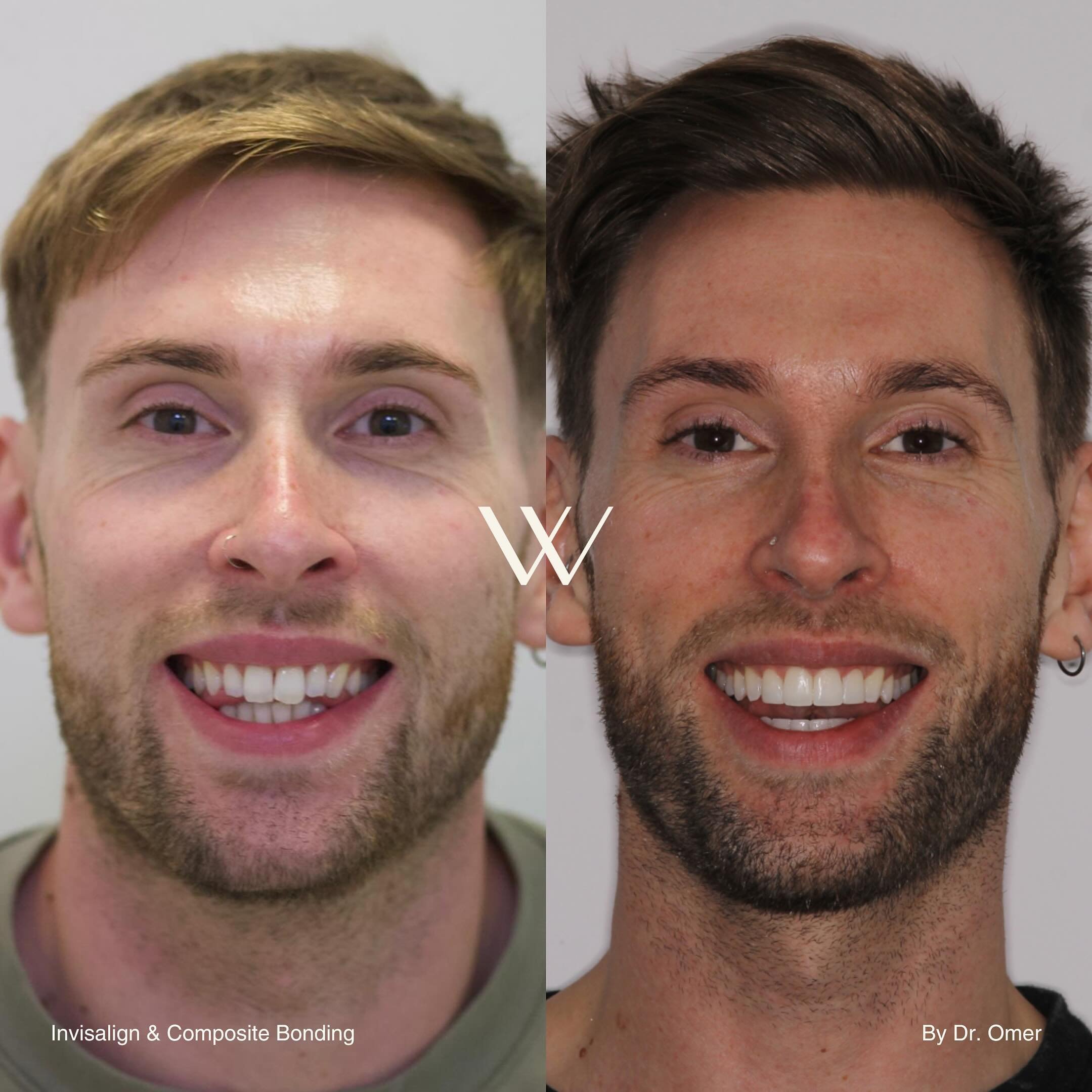 Witness the power of a smile makeover! 🦷✨ @omer_ortho  expertise shines through in this remarkable transformation achieved with Invisalign and perfected with composite bonding. Ready to transform your smile? Book your FREE consultation today! #Smile