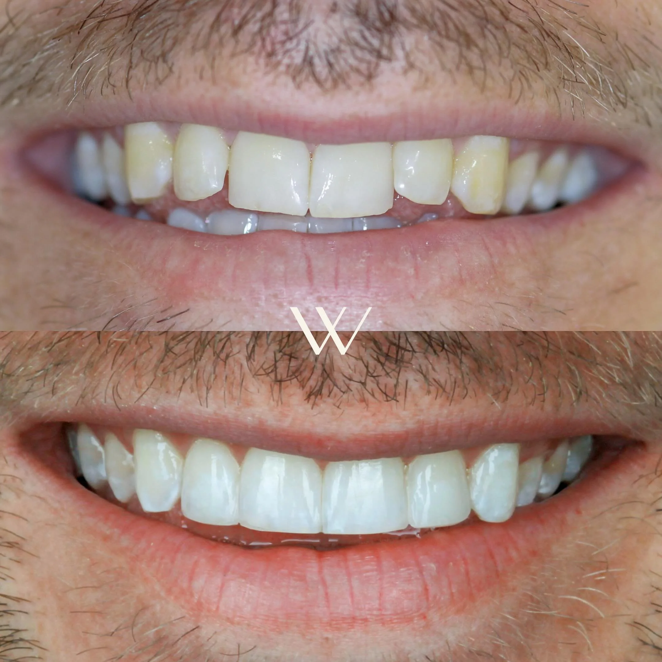 ✨ What do you all think of this stunning smile makeover created by @omer_ortho ? ✨
If you’re looking to improve your smile, give us a DM now to see how we can help! 🦷💫 #SmileMakeover #Invisalign #SmileTransformation #WestgateDentalStudios