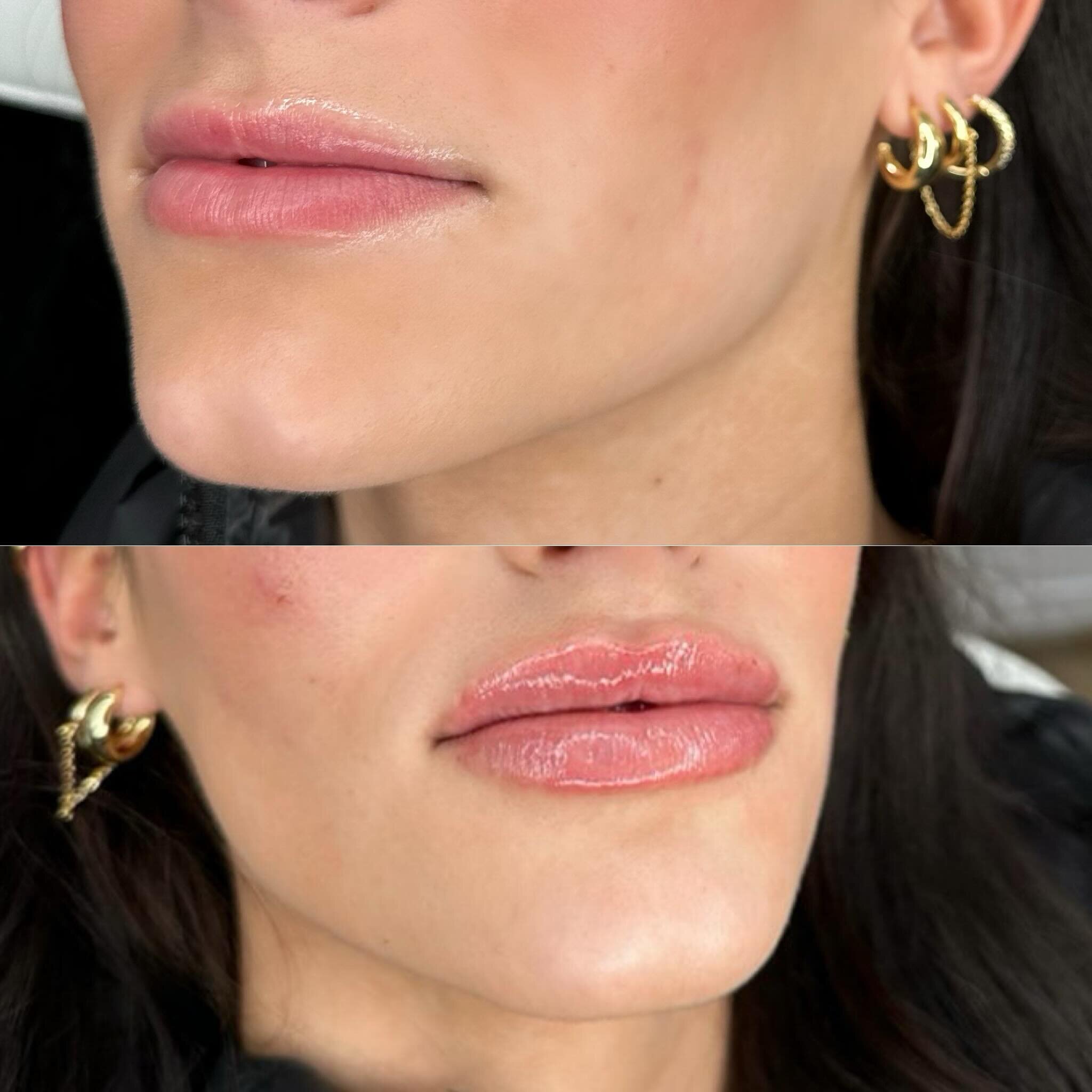 BEFORE lip filler and immediately AFTER one syringe 👄💉 

Lip filler is the perfect solution to creating symmetry, definition, volume, and self-confidence! 💄

Lip filler does not have to look unnatural. It can be so natural-looking and compliment t