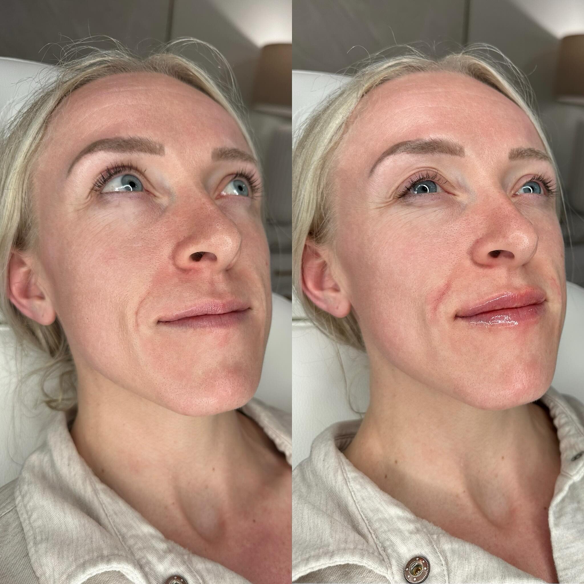 Lip filler appreciation post 👏 I&rsquo;m obsessed with what lips can do for the entire face! She&rsquo;s stunning before and after! But our favorite part? Her upper lip no longer disappears when she smiles 🥹

Lips DO NOT have to look unnatural. 
I 