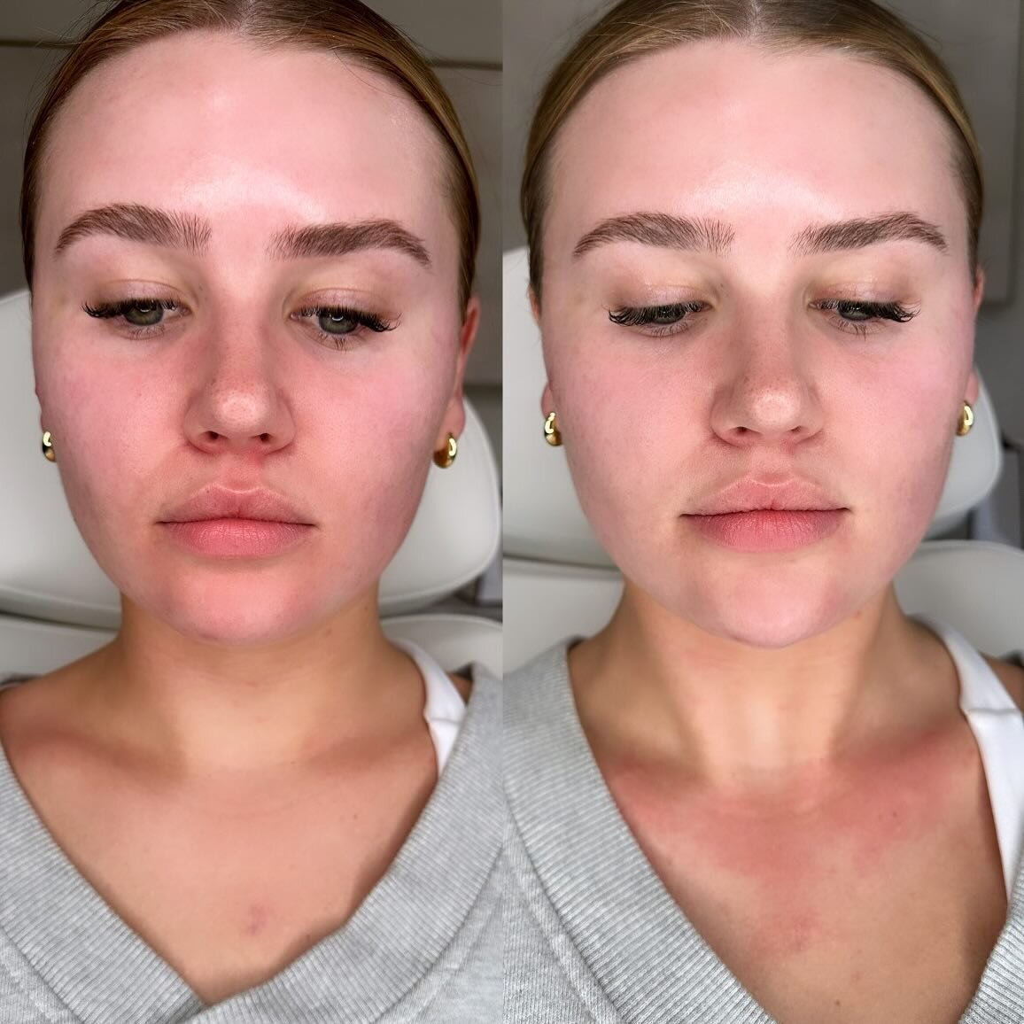 Can you tell what we did without reading the rest of this post?? 😏

A beautiful, feminine chin for this stunning girlie 🫶🏽 Her goal was to elongate her face shape and I think we absolutely slayed 🥵 

Such a subtle yet impactful result using 1 syr