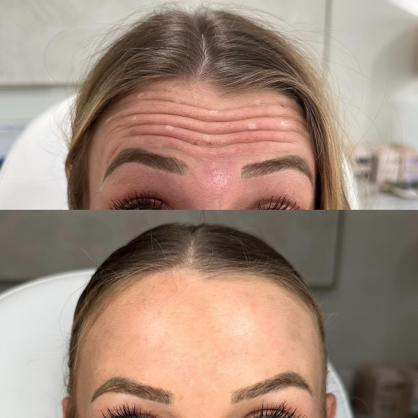 Excuse my markings in the top pics 🤪 I&rsquo;m just grateful I remembered to take the pictures! 👏 Because who doesn&rsquo;t love seeing befores and afters for Botox/Dysport?! 🔥

Top pictures are taken immediately before injections. Bottom pictures