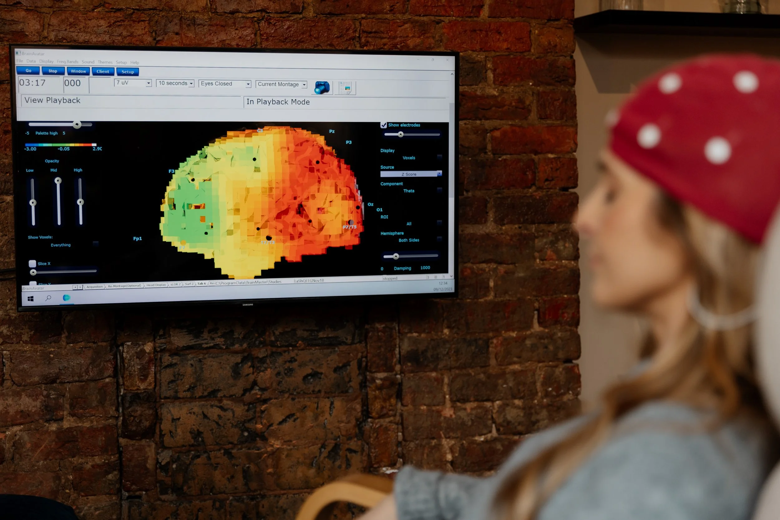 QEEG showing the brain in 3D