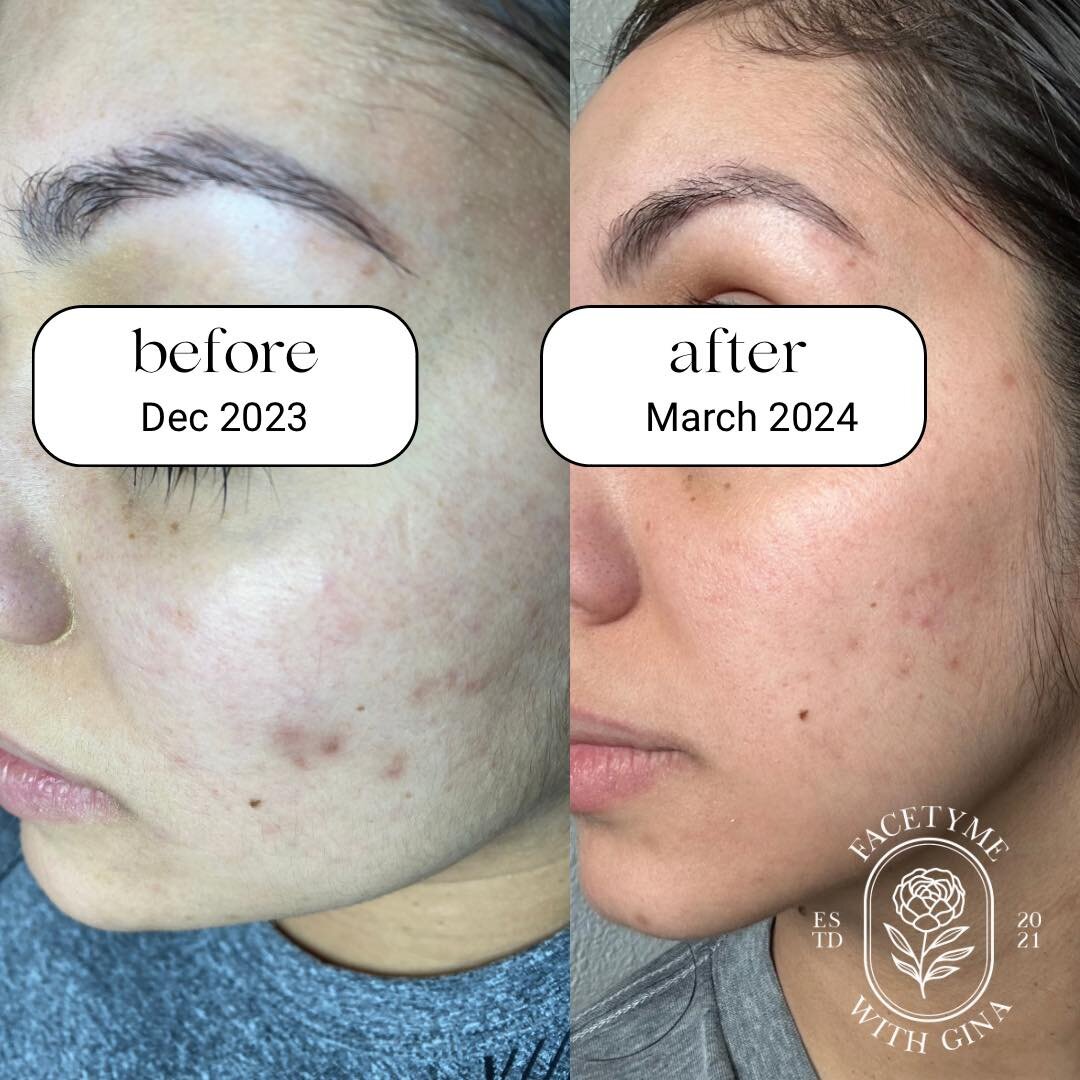 VIRTUAL CLIENT UPDATE

11 weeks on a PERSONALIZED skincare regimen for acne. 

Despite a stressful job, hormones and a busy mom her acne is coming into control with this PERSONALIZED program developed by Facetyme with Gina. 

&ldquo;My skin feels gre