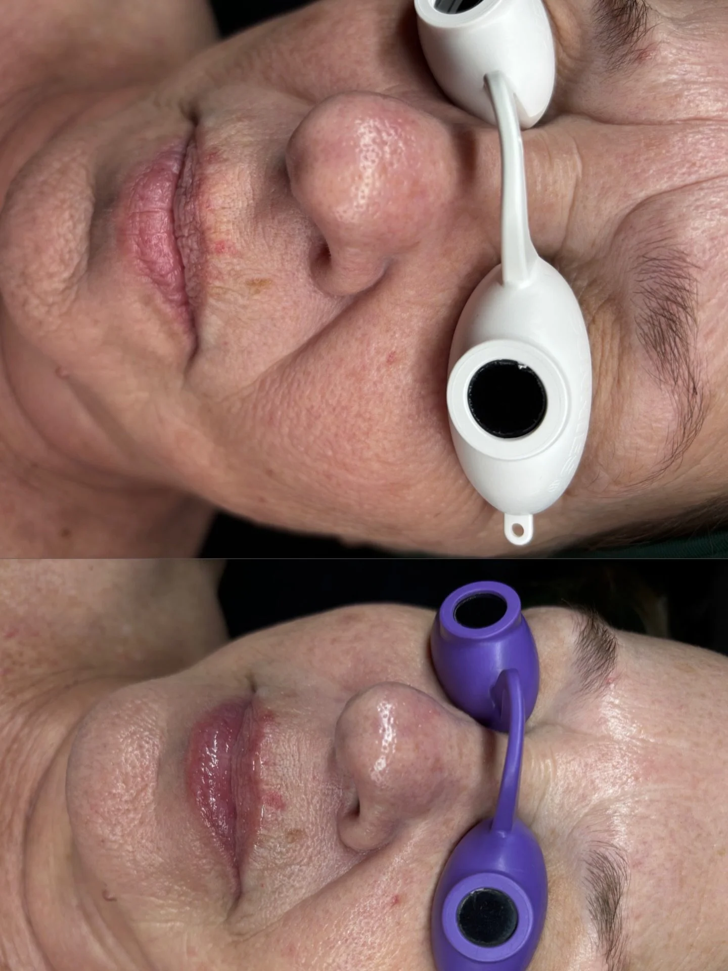 This is ONE facial ya&rsquo;ll. 

Look at the relaxation of those &ldquo;11s&rdquo; between the brows.

The wrinkles much less significant above the lip and the lines by the cheeks. 

This is why facials make a difference. 

I can jump start your ski