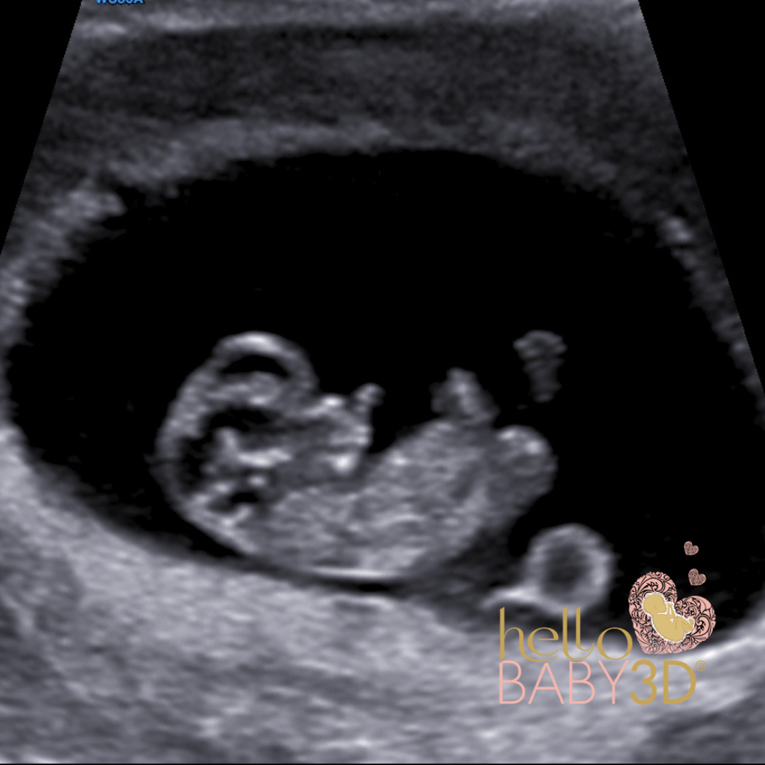Reassurance 3D Pregnancy Ultrasound (7-13 weeks).png