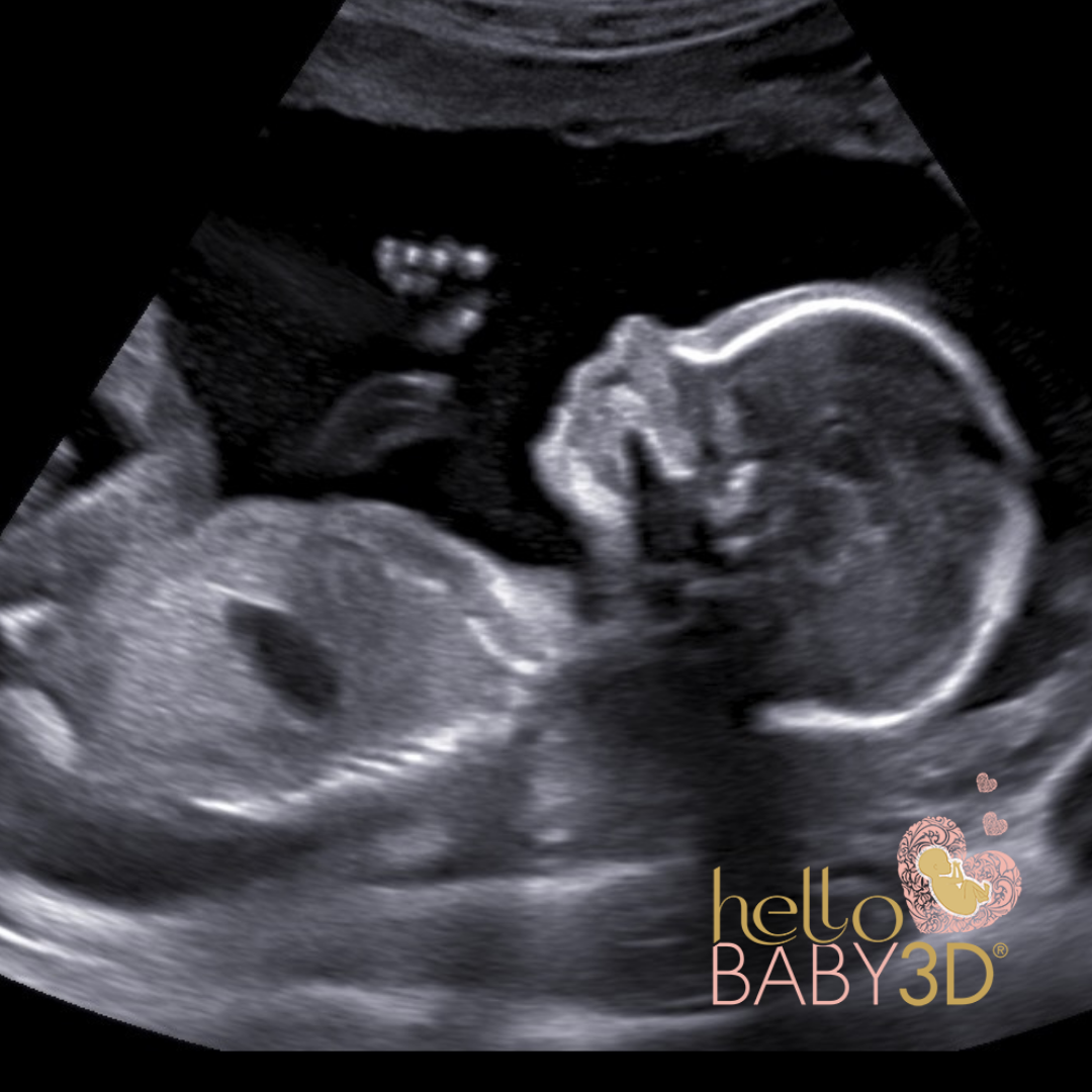 2D Gender Pregnancy Ultrasound (14 to 40 weeks) (2).png