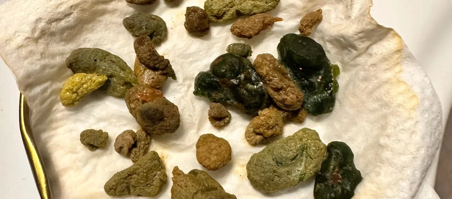Dozens of actual gallstones released during Ana Cristina's 7 Day Liver Flush Protocol following Quantum Bioresonance Treatment with Nik Heartsong at Winged Heart Healing - green, tan, and dark stones of varying sizes displayed on a coffee filter