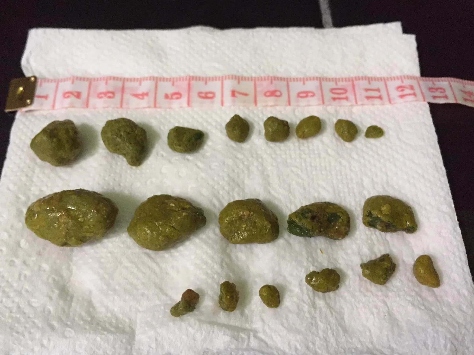Real gallstones released during a liver gallbladder cleanse with Nik Heartsong Winged Heart Healing image showing over 10 large green gallstones of various sizes