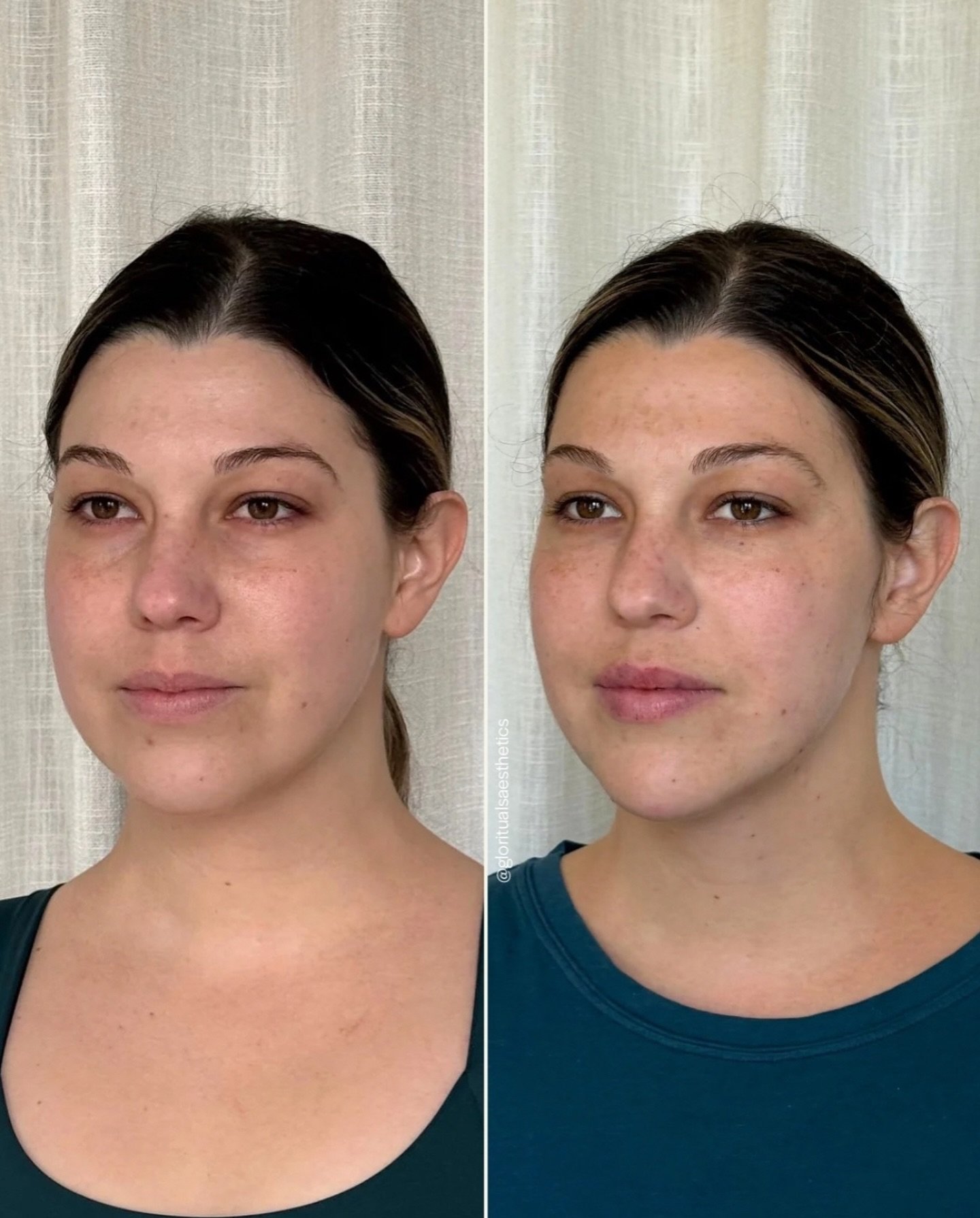 Balance. Soft transitions. Ideal light reflection✨

That was the vision, and this is the result.

We achieved this refreshed, natural look with a custom combination of:

💉 Precisely placed facial balancing filler
💉 Dysport to soften wrinkles, lift,