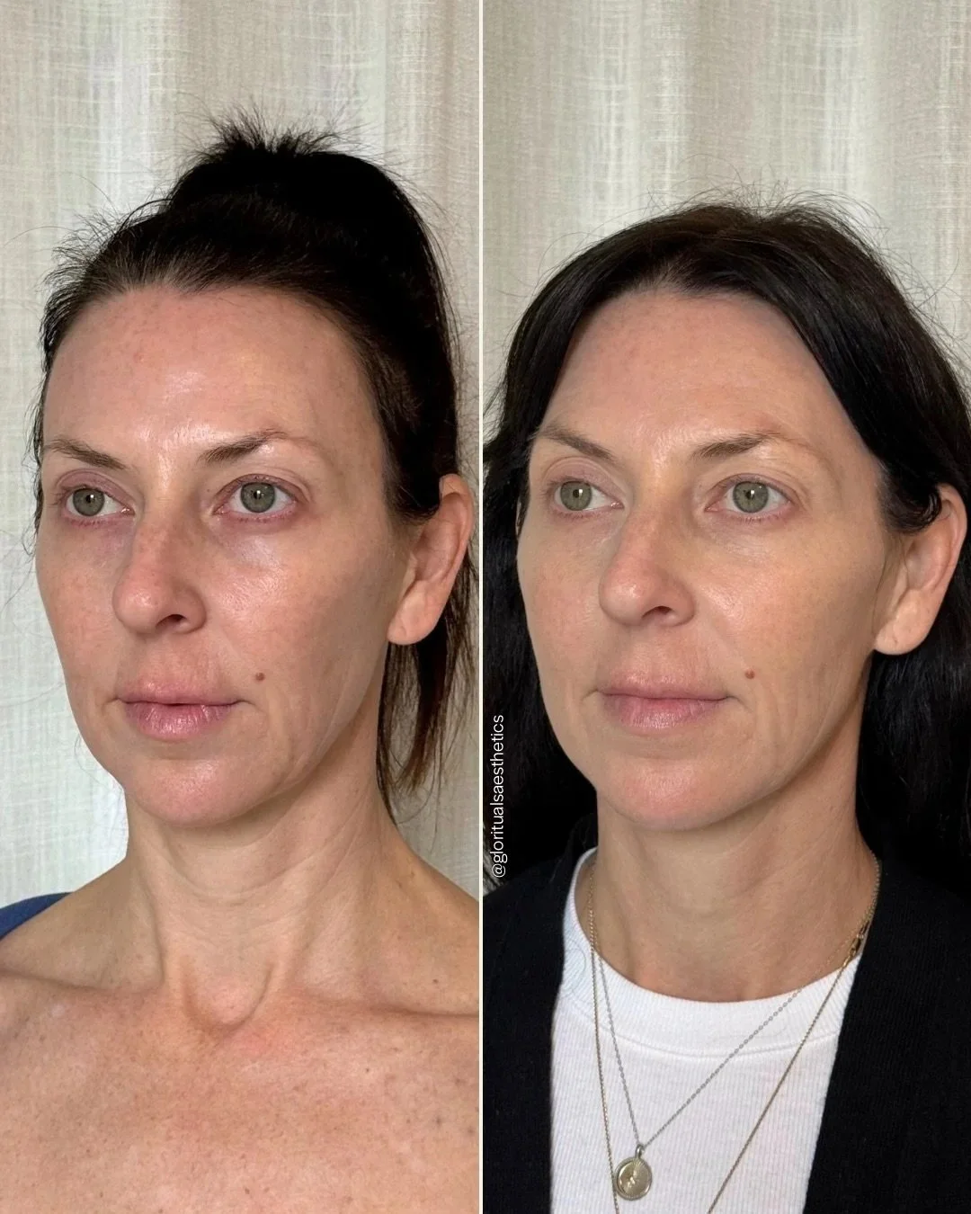 Treatments: Dysport, PRF EZ Gel Undereys, Microneedling Full Face & Neck