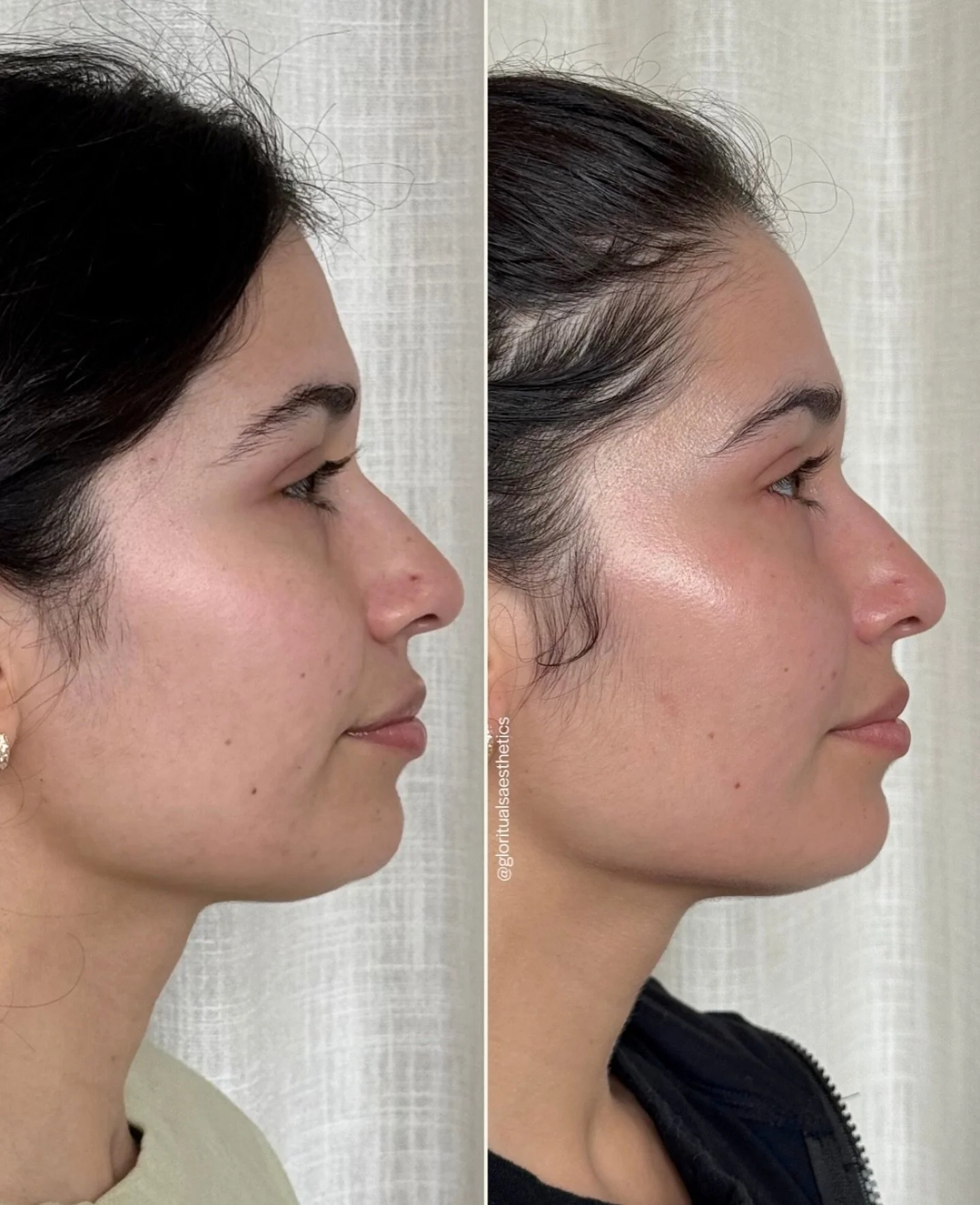 Her skin transformation speaks for itself.

Treatment stack:
▪️ Microneedling face and neck with PRF (PDGF now available for even better outcomes!)
▪️ PRF liquid injections to the under eyes
▪️ Rejuvenize Peel

Each treatment was strategically layere