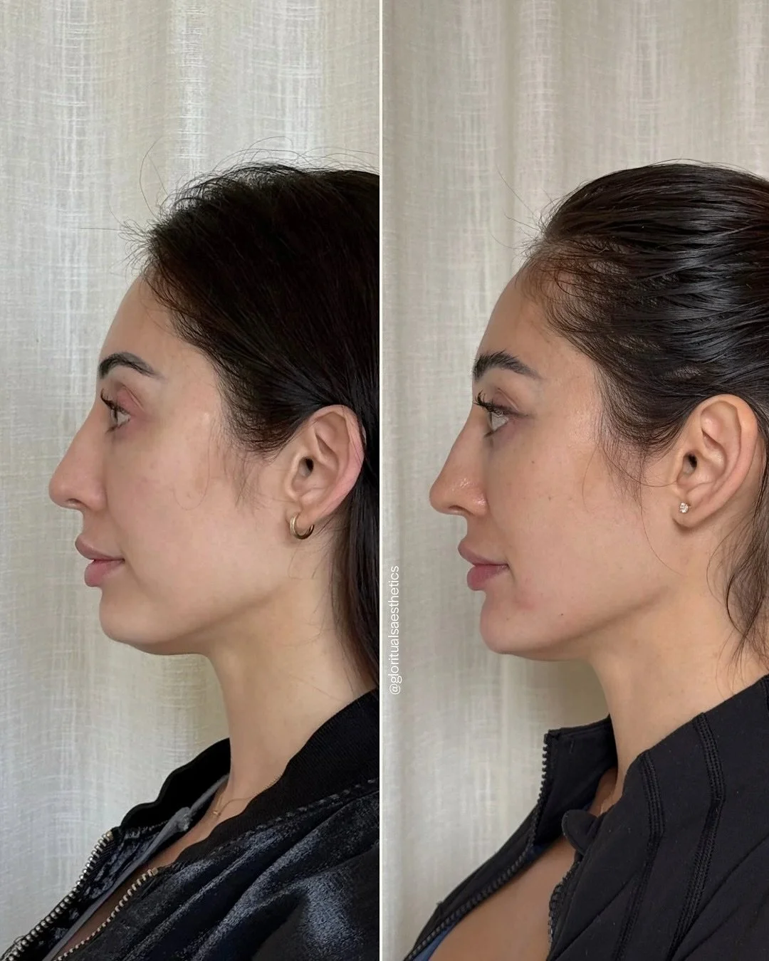 The chin is an extremely important structure to facial balance&hellip;

And you&rsquo;ll never convince me otherwise. 

The chin plays a crucial role in facial harmony &ndash; and it&rsquo;s all about RATIOS ✨

Beautiful, natural results don&rsquo;t 