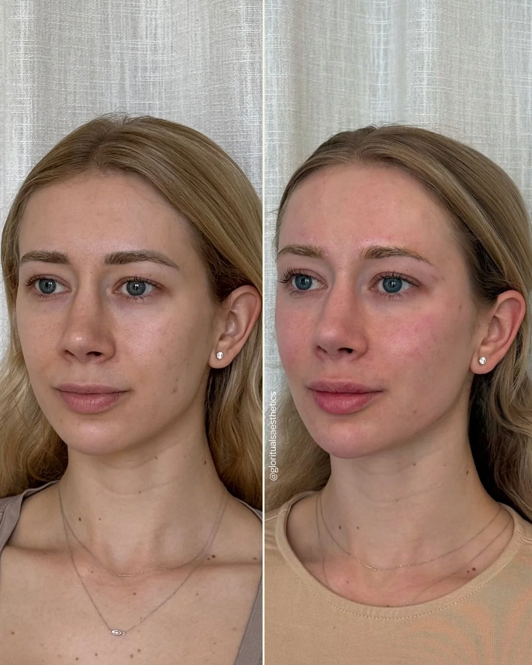 When looking like yourself is the goal.

After 7 months of thoughtful transformation, this is what &ldquo;looking like yourself, but better&rdquo; truly means. Through a comprehensive approach including full facial balancing with filler, Dysport inje