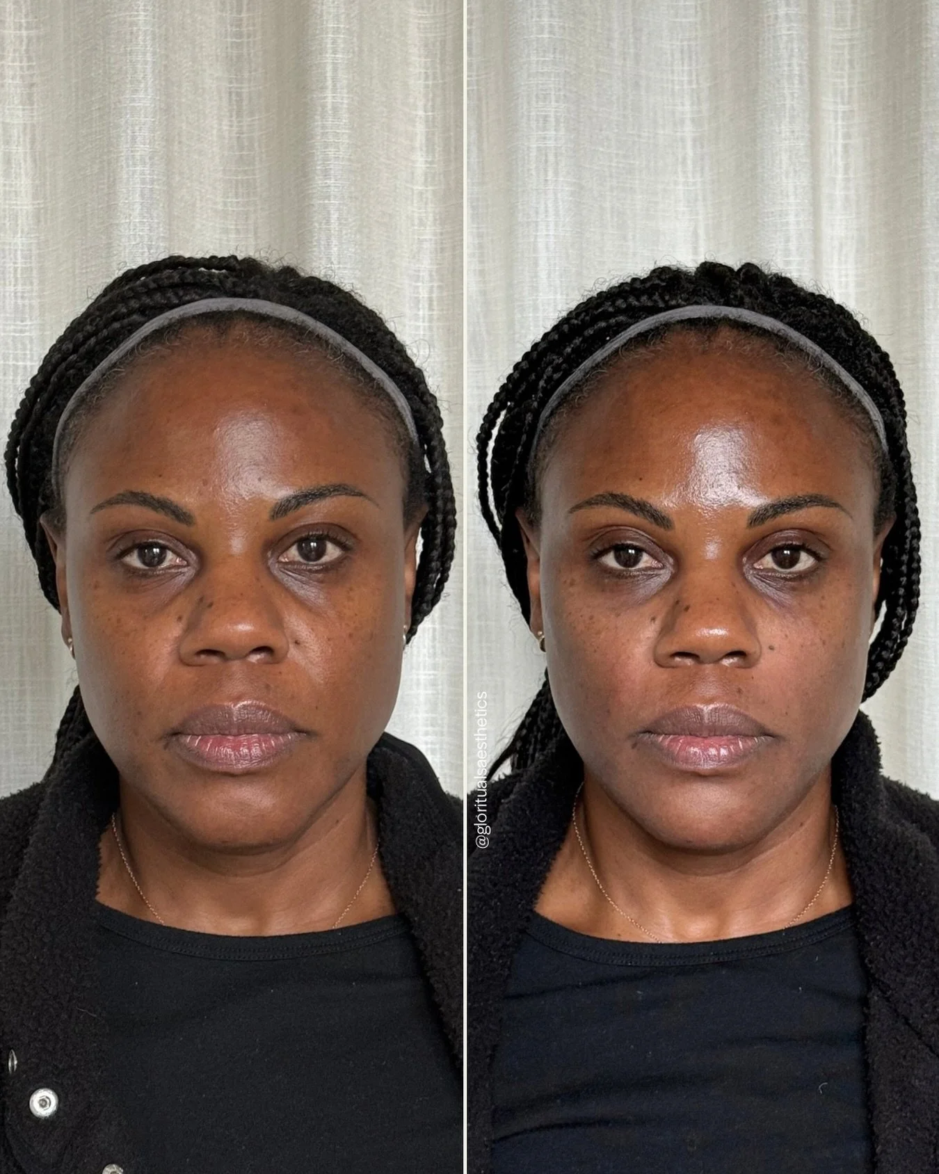 Refreshed. Softened. Balanced.

That&rsquo;s the goal of true facial balancing.
Thoughtful technique and precision are at the heart of how I approach filler&mdash;because no two faces (or aging patterns) are ever the same.

For this beauty, we focuse