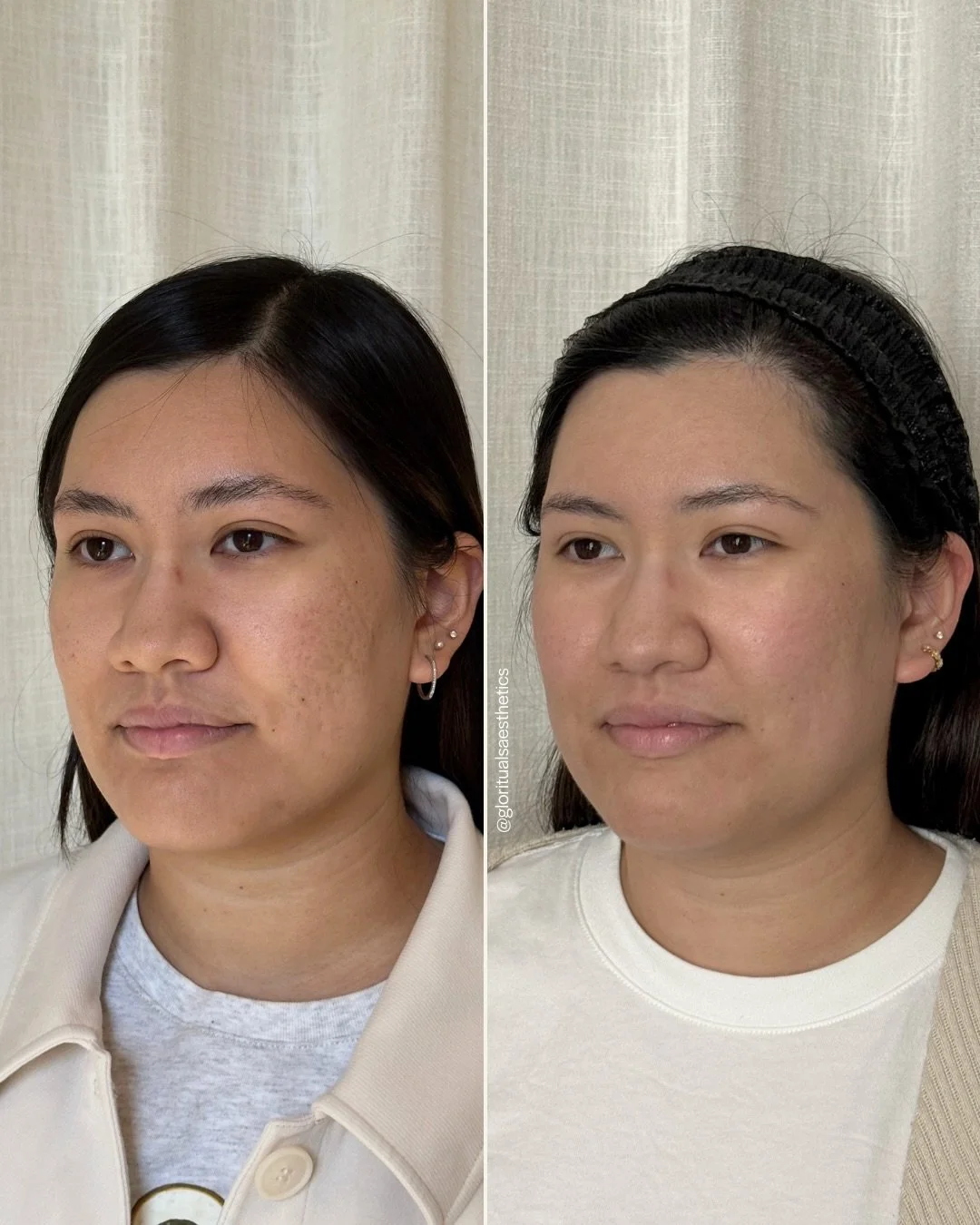 A moment for her skin ✨
⠀⠀⠀⠀⠀⠀⠀⠀⠀
This patient came to me with concerns about her skin texture. She had long been wanting heal her acne scaring and trusted me to restore her skin health. 
⠀⠀⠀⠀⠀⠀⠀⠀⠀
Here&rsquo;s what we did and why it worked.
⠀⠀⠀⠀⠀⠀⠀⠀