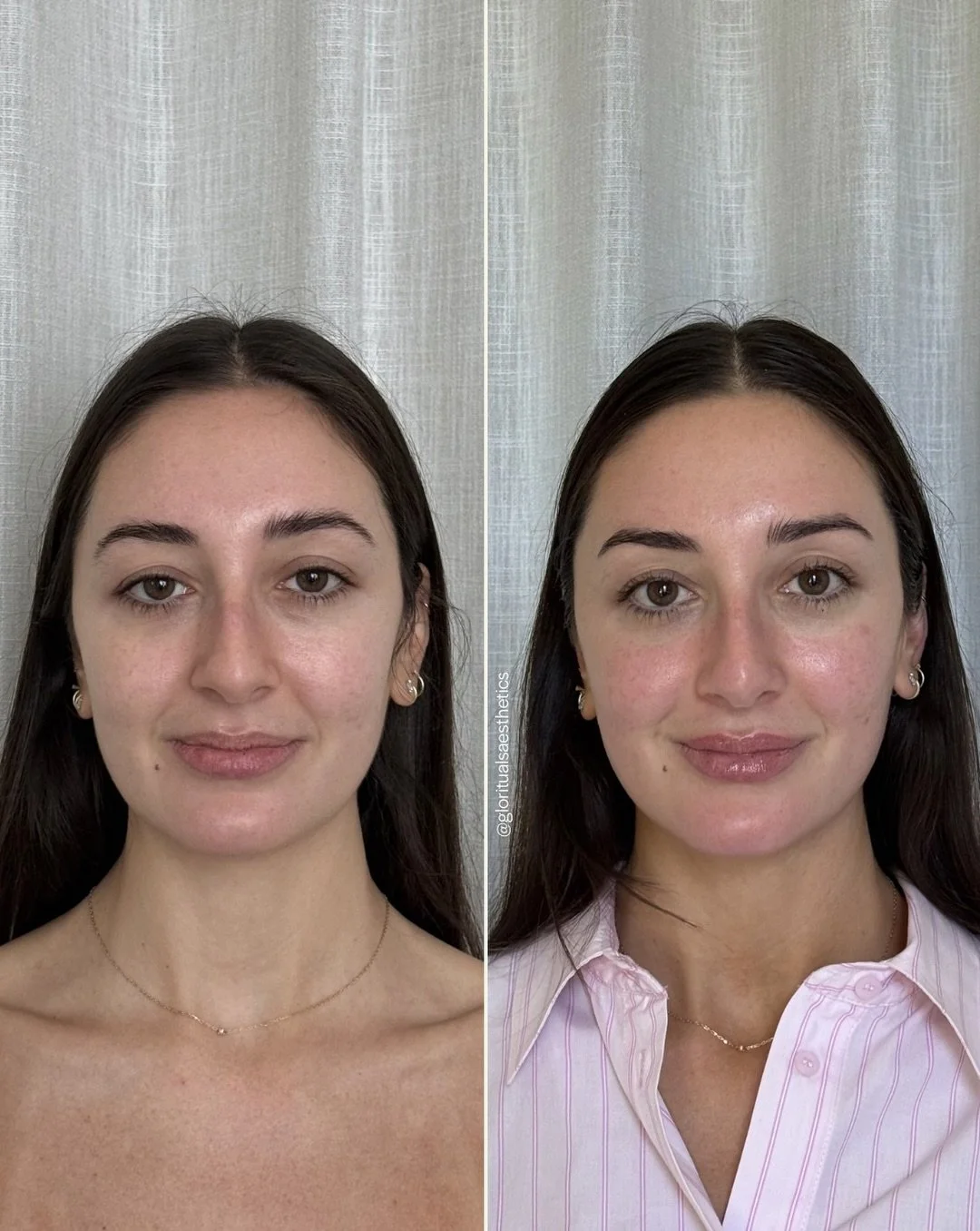 R E F R E S H ED ✨

This natural and essence preserving result was brought to you with a restrained approach that prioritizes harmony over trends, subtlety over excess, and long-term results over quick fixes. 

Treatments done so far:
- Hydrafacial
-