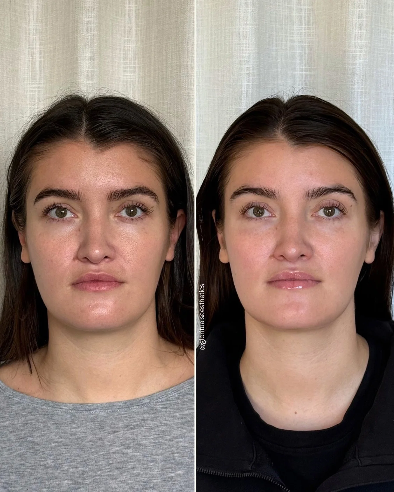 There&rsquo;s a difference between treating your skin and maintaining your skin.

This is what maintenance therapy can look like. ✨

This patient is consistent with her treatments, and this specific result came from a strategic combination of Aerolas