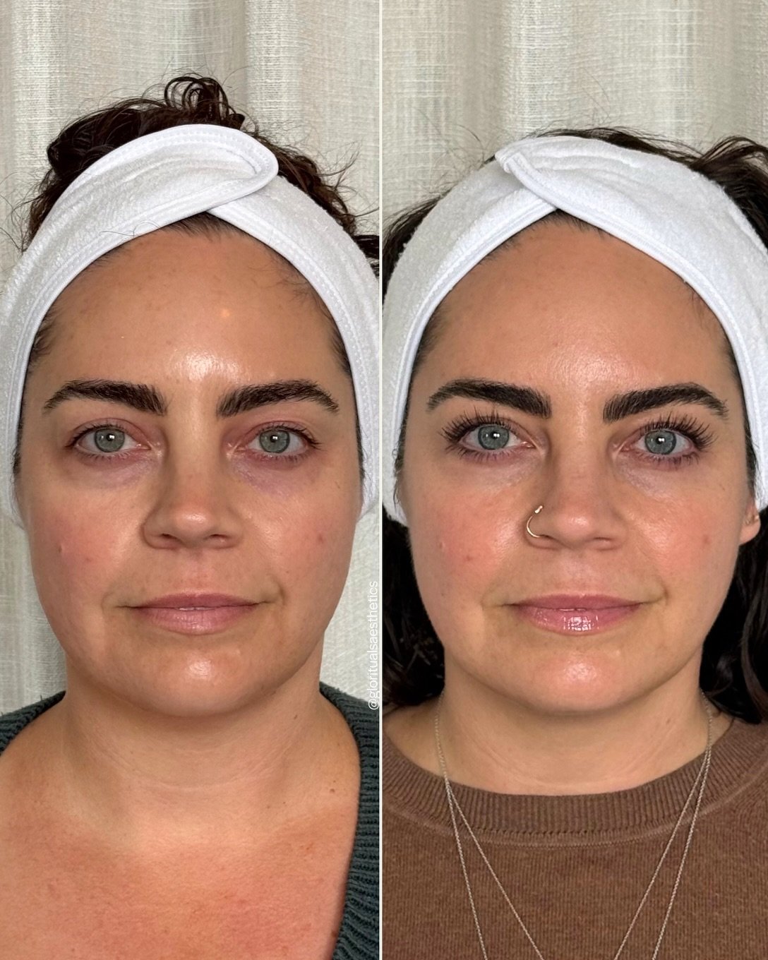What one customized treatment with our Deka Helix CO2 laser achieved

DEKA Fusion treatment | Full Face + Eye Rejuvenation + Neck ✨ one month post treatment before and after

Healthy skin is the foundation of beautiful skin.

With her customized lase