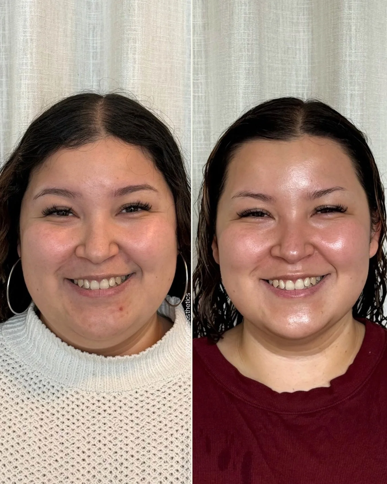 She came in asking for filler. I said no. I had a better idea. 

Not because filler was &ldquo;wrong&rdquo; for her, but because I didn&rsquo;t believe it was the first thing she needed.

We started with the foundation: her skin.

Her journey with us