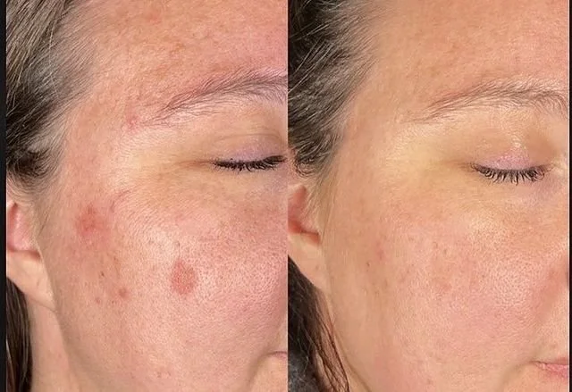 Hyperpigmentation 