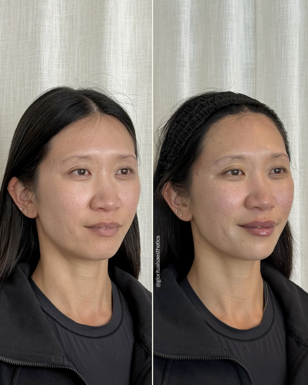 Side-by-side comparison of a woman before and after a skincare procedure, showing improved skin texture and tone in the after photo.